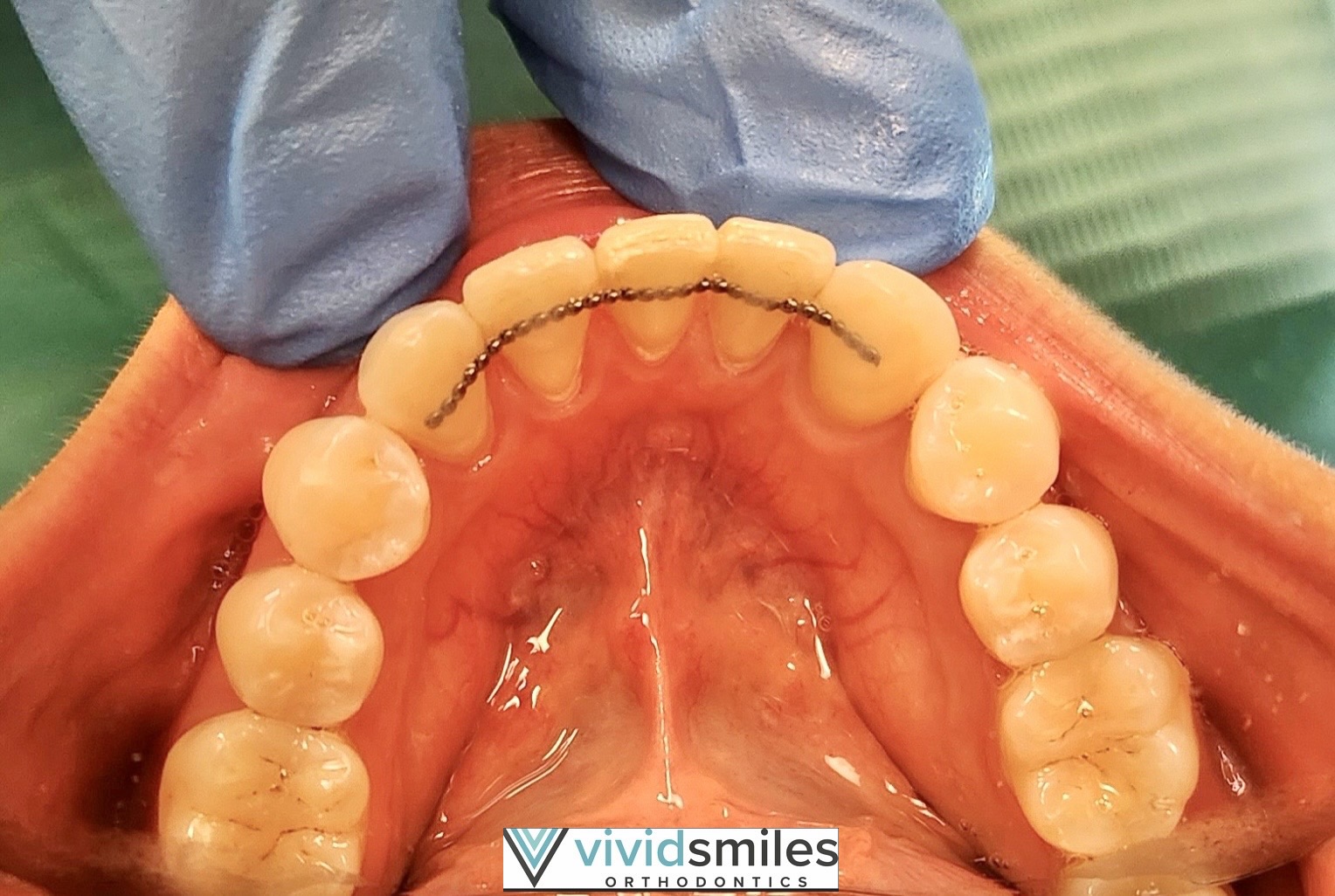 Bonded retainer wire fixed behind the front teeth