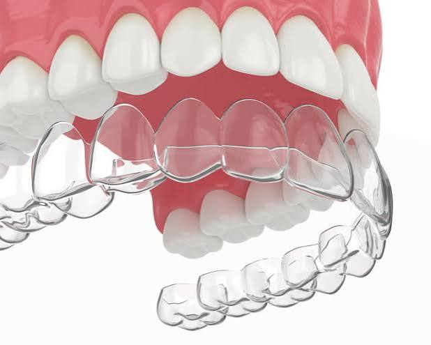 Clear Essix retainer molded to fit over the teeth