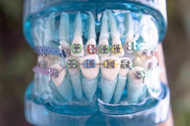 Traditional metal braces